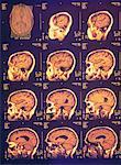 MRI-Composite-Bild des Gehirns