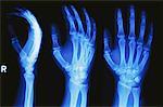 Rechten Hand Röntgen