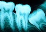 Radiographie de la dent de sagesse impactés