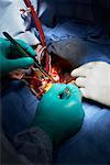 Doctors Performing Open Heart Surgery