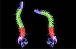 Spondylitis