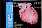 Computer monitor displaying CAT scan image of heart