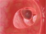 3d rendered anatomy illustration of a big bowel polyp