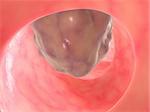 3d rendered anatomy illustration of a big bowel tumor