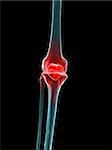 3d rendered x-ray illustration of a human knee with pain