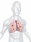 3d rendered anatomy illustration of human upper body with lung infection