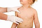 Kid torso with small pox consulted by a physician - isolated, closeup