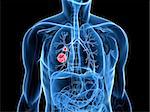 3d rendered x-ray illustration of a transparent body with carzinoma in lung