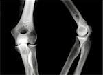 X-Ray picture of knees front and side view