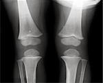 Knees on x-ray film