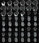 MRI human head scan