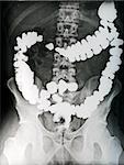 Abdomen radiography with contrasted intestine