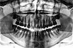 Dental scan x-ray negative of a 35 year old man.