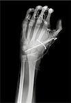 Fixed broken finger of Fist on x-ray film