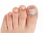 Broken big toe with nail detachment on pure white background