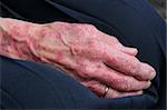 Extreme sceriosis on the hand of an elderly female.