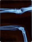 Right elbow radiography. Open and closed position