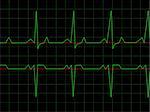 Normal Heart Rhythm electrocardiogram ECG graph with black background