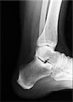 Actual xray of an injured heel in a human foot