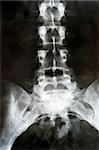 X-RAY film of  lower thorax and pelvis.
