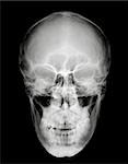 Front view of human head on black and white x-ray film