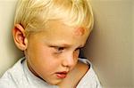 BOY WITH BRUISED FOREHEAD