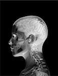 X Ray image of the inside of a womens head.