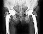 radiography of operation of implantation of two prostheses in the hips of a person