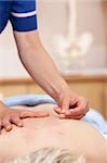 Acupuncturist treating female client