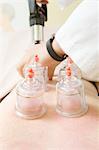 Chinese traditional cupping therapy for improved circulation