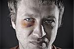 Man with an injured eye. Closeup, toned.