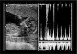 ultrasound fetus at 12 weeks