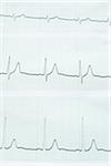 close-up of an electrocardiogram report