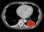 Image from a co-registered PET-CT study from dual modality scanner. Patient with multiple metastatic lesions in liver & lung. PET data superimposed over CT scan axial slice through lung metastases