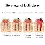 Tooth decay formation step by step, forming dental plaque and finally caries and cavity. Also available as a Vector in Adobe illustrator EPS 8 format.