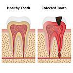 Illustration showing pulpitis and healthy tooth. Also available as a Vector in Adobe illustrator EPS 8 format.