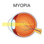 Myopia is being short sighted. Far away object seems blurry. Detailed anatomy of the eye. Also available as a Vector in Adobe illustrator EPS 10 format.