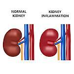 Healthy kidney and kidney infection with the virus. Also available as a Vector in Adobe illustrator EPS 10 format.