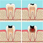 Dental caries stages. Cross section tooth anatomy and damage.