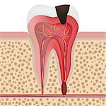 Vector illustration showing infected tooth with pulpitis. Also available as a Vector in Adobe illustrator EPS 8 format.