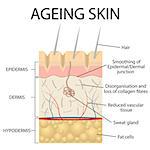 Old skin anatomy characterized by presence of age spots and wrinkles caused by loss of collagen fibers, atrophy of epidermis and blood vessels. Also available as a Vector in Adobe illustrator EPS 10 format.
