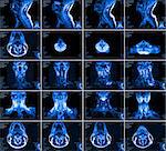 Magnetic resonance imaging of the cervical spine. MRI vertebral discs in different views