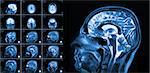 Magnetic resonance imaging of the brain with no visible abnormalities. MRI in different views