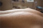 Close-up of a patient getting dry needling
