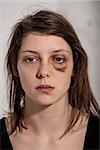 black-and-blue eye of a woman victim of domestic violence and abuse