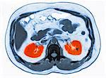 CT scan of abdomen with small kidney stone