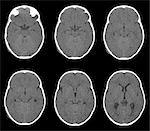 head CT scan, girl, fracture, subdural hematoma