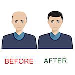 Man with alopecia before and after hair treatment and transplantation. Also available as a Vector in Adobe illustrator EPS 10 format.