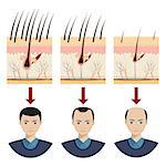 Hair loss stages with male portraits. Also available as a Vector in Adobe illustrator EPS 10 format.