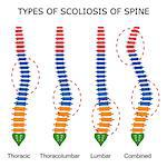 Illustration of types of scoliosis of spine on the white background. Also available as a Vector in Adobe illustrator EPS 10 format.